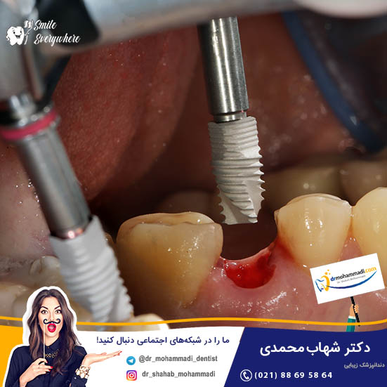 احساس سفتی و کبودی در گونه بعد از سینوس لیفت و ایمپلنت  - کلینیک دندانپزشکی دکتر شهاب محمدی